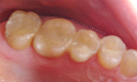 Resine dentali