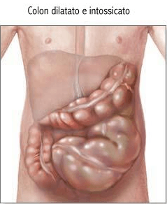 Colon intossicato