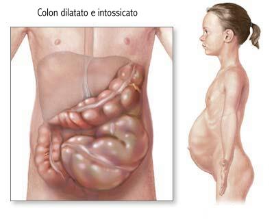 colon dilatato