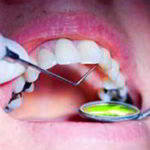 denti devitalizzati