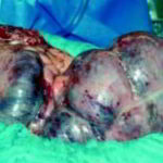 colon incistato con fecalomi