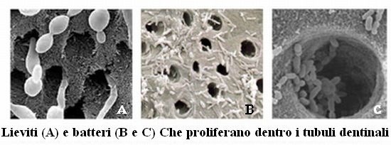 lieviti e batteri nei tubuli dentinali