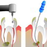 devitalizzazione denti