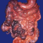 Colon malato