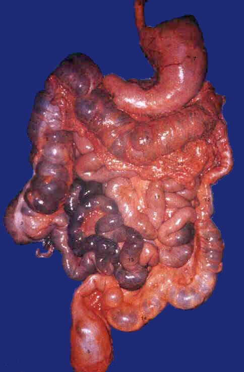 Il colon, sistema fognario o pozzo nero? 1 Colon malato